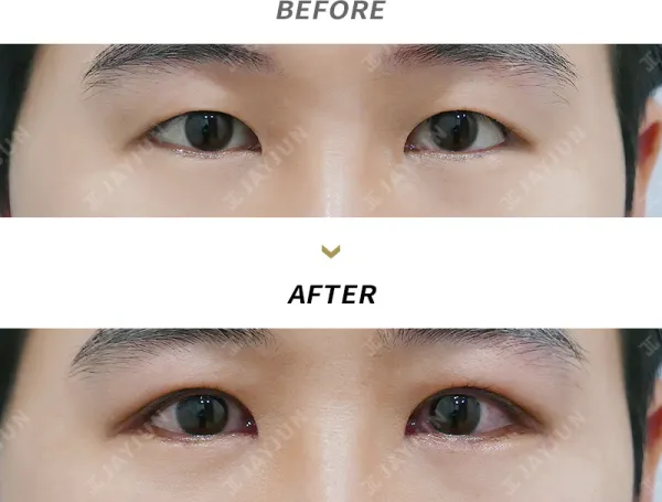 Before/After