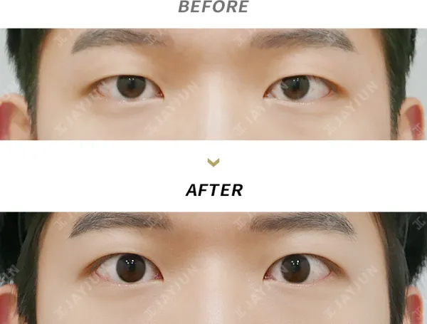 Before/After