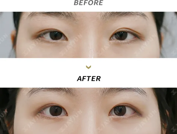 Before/After