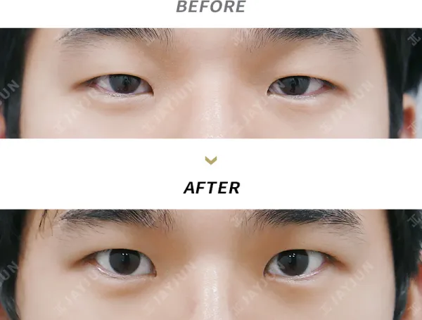 Before/After