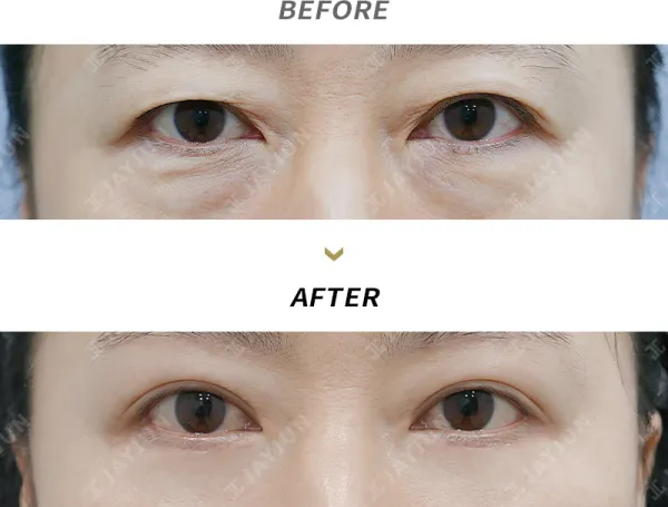 Before/After