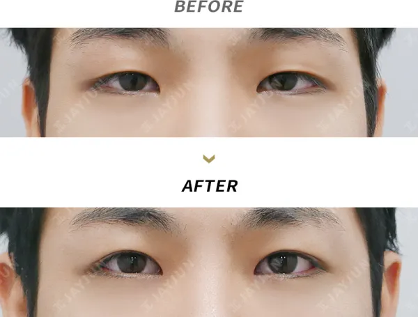 Before/After