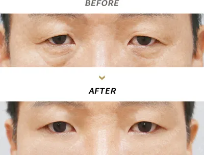 Before & After