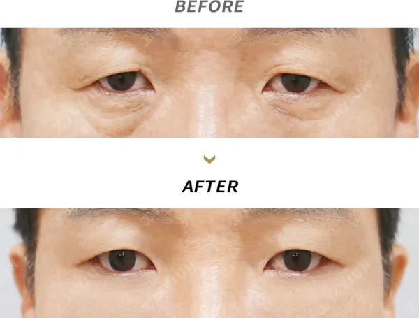 Before/After