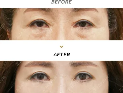 Before & After
