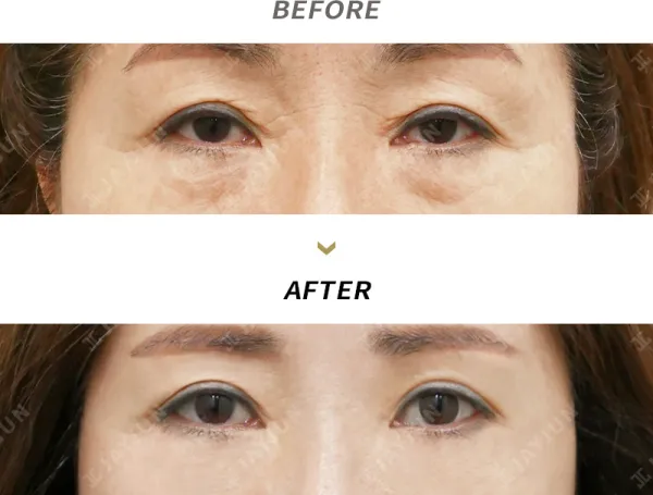 Before/After