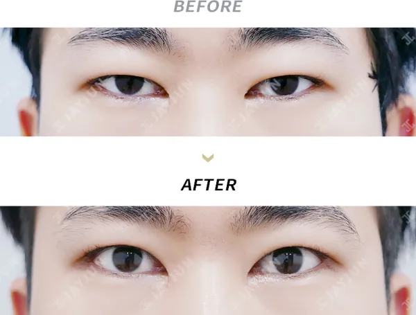 Before/After
