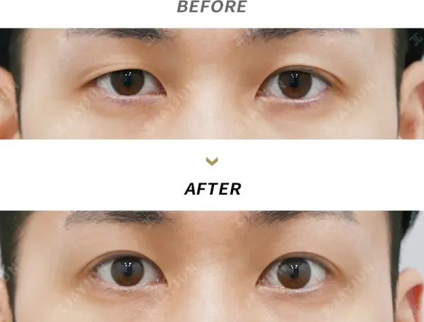 Before/After
