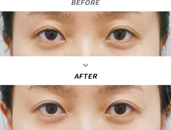 Before/After