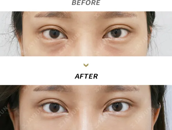 Before/After
