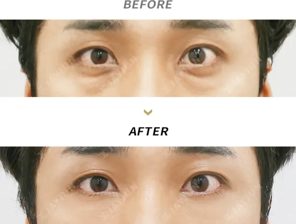 Before/After