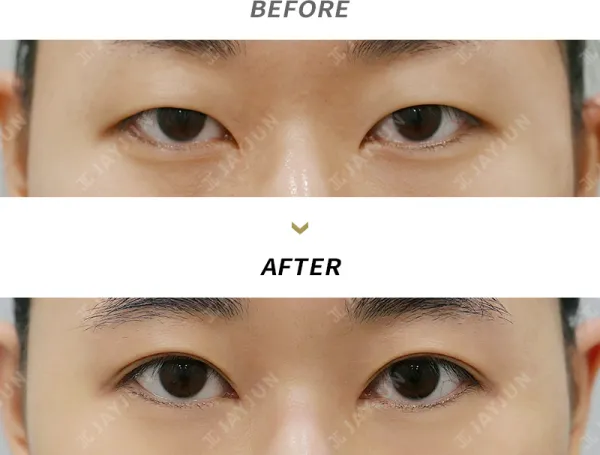 Before/After
