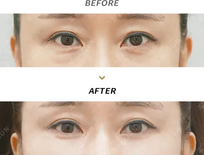 Before & After