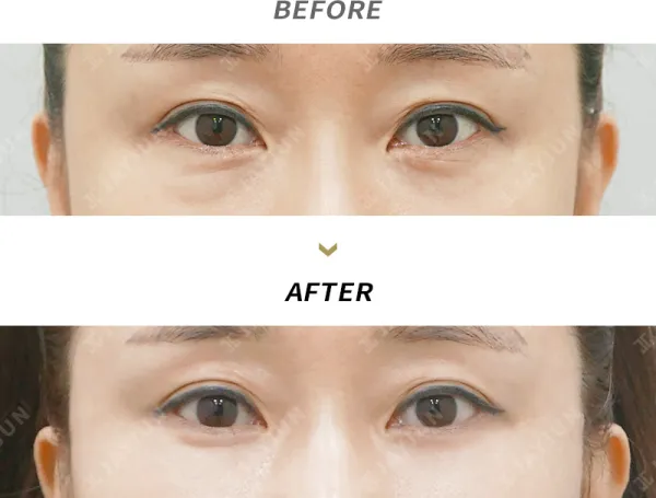 Before/After