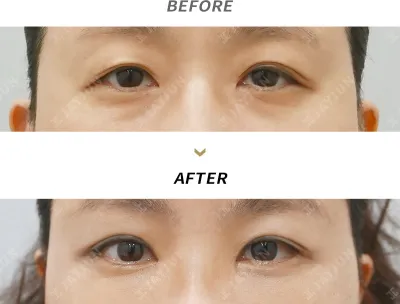 Before & After