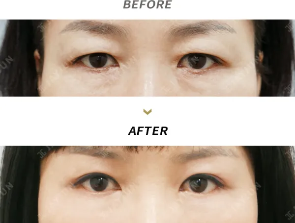 Before/After