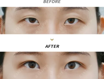 Before & After