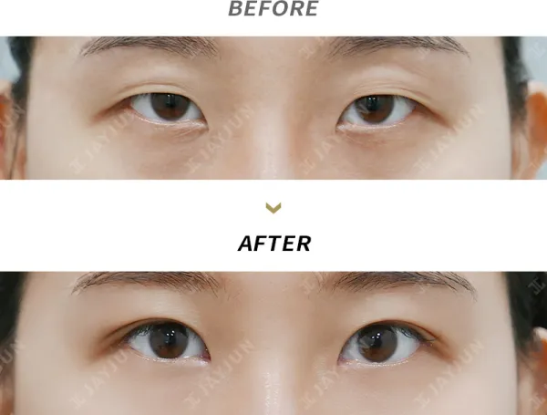 Before/After