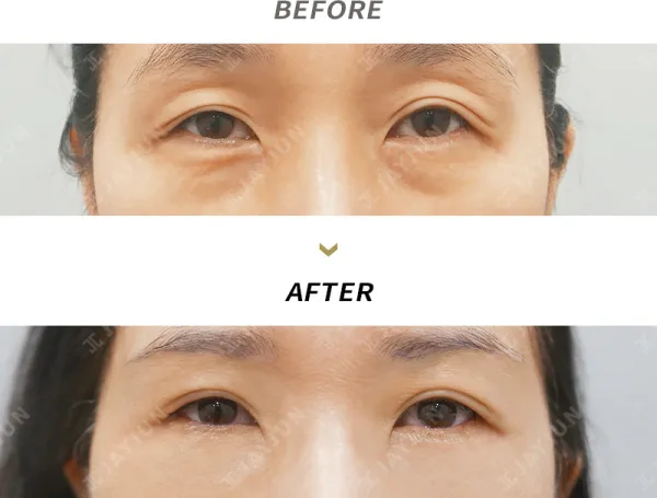 Before/After