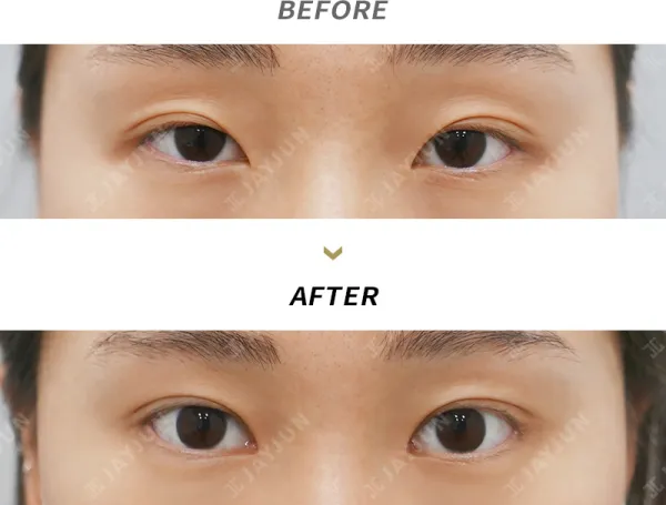 Before/After