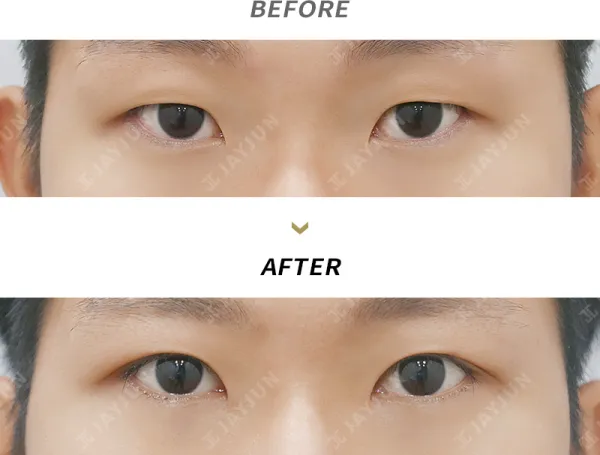 Before/After