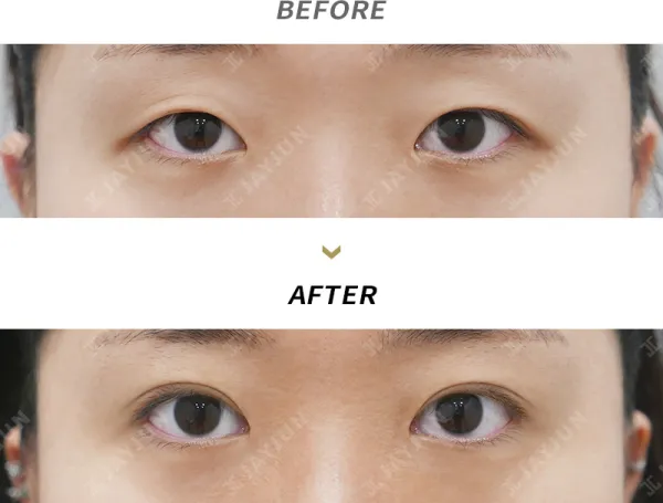 Before/After