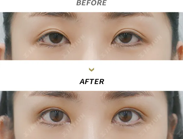 Before/After