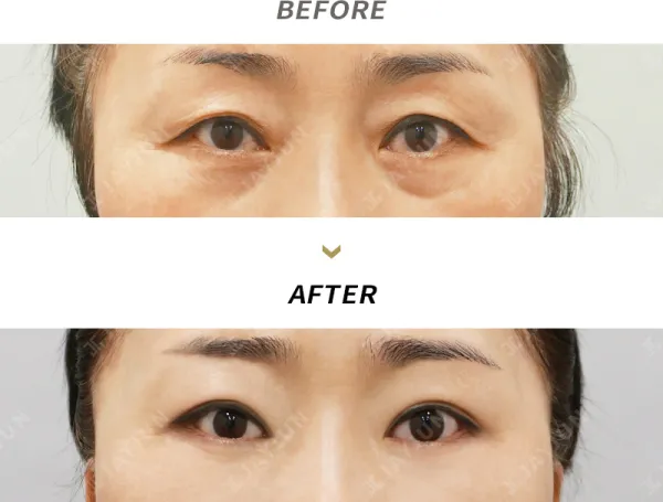 Before/After