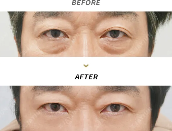 Before/After