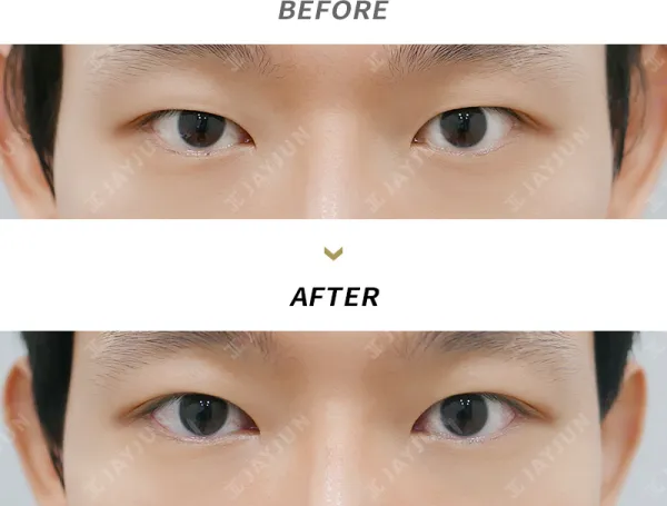 Before/After