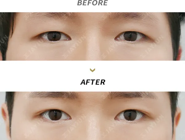 Before/After