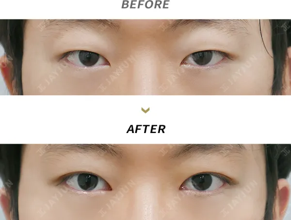 Before/After
