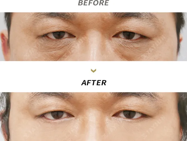 Before/After