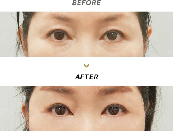 Before/After