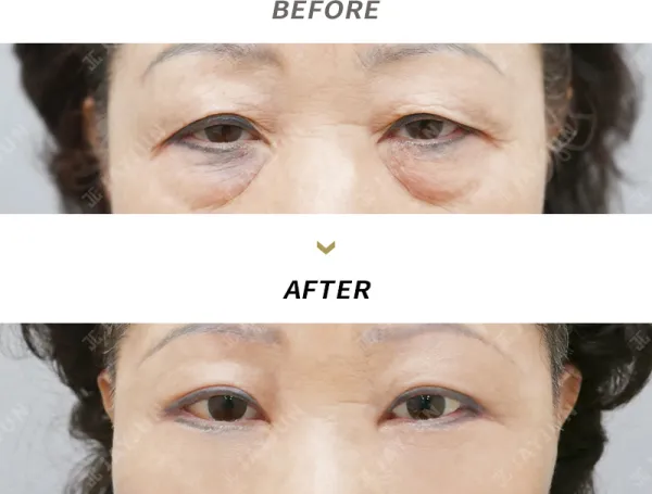 Before/After