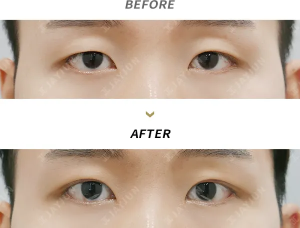 Before/After