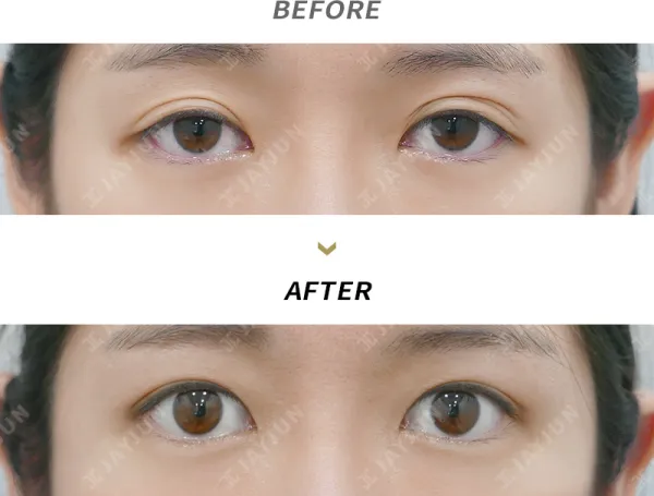 Before/After