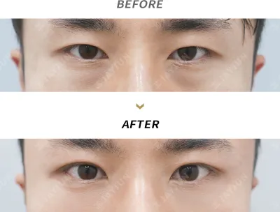 Before & After