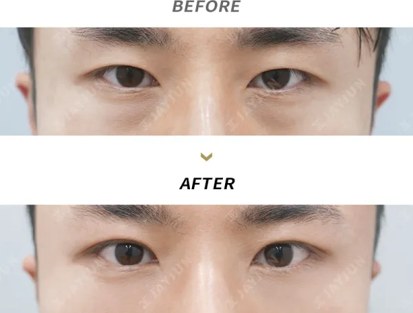Before/After