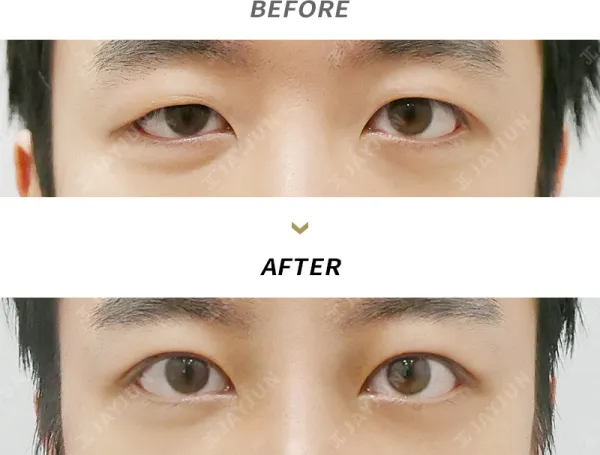 Before/After