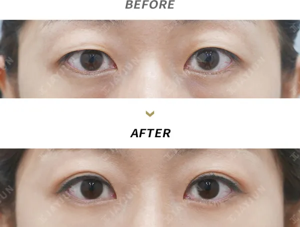 Before/After
