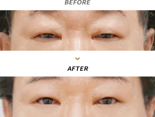 Before/After