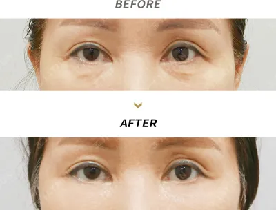 Before & After