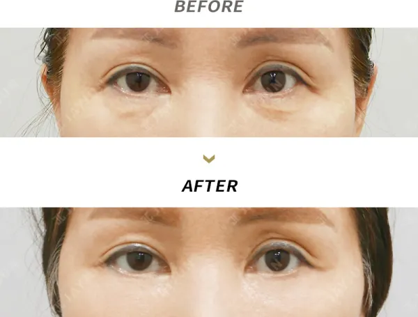 Before/After