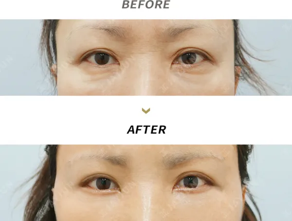 Before/After