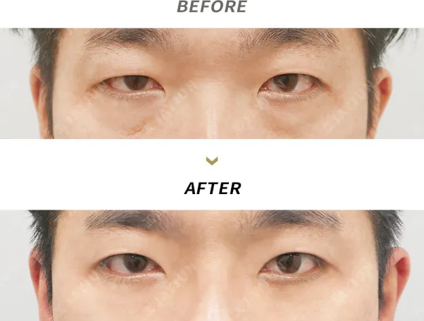 Before/After