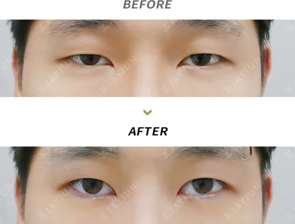 Before/After