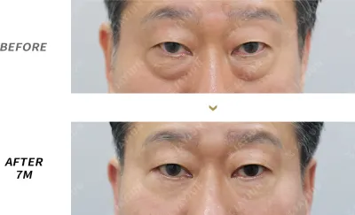 Before & After
