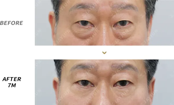 Before/After
