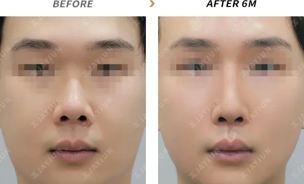 Before/After